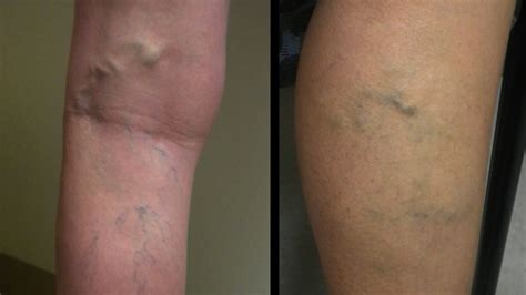 Suffer From Varicose Veins Study Shows Link To Blood