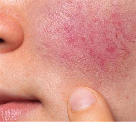Rosacea Nrs Approved Features Thederm