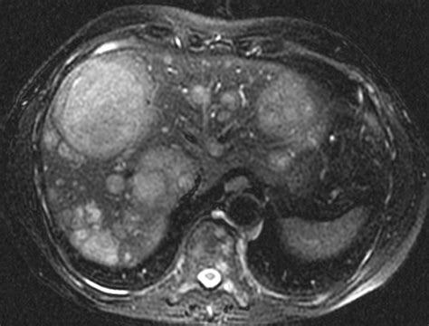 Anatomic And Functional Imaging Of Metastatic Carcinoid Tumors