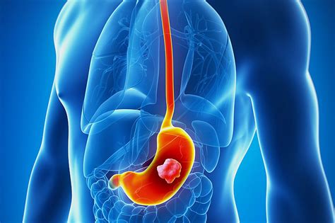 8 Warning Signs Of Stomach Cancer Geelong Medical And Health Group
