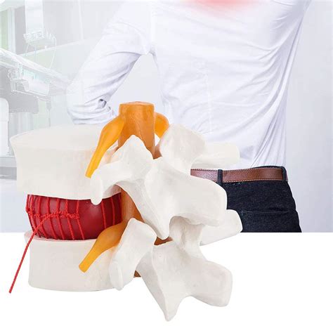 Buy Body Model Human Lumbar Disc Herniation Model Anatomical Human Spine Model Human Spine