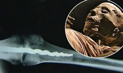 Was Surgery Performed On Egyptians Prosthetic Pin In 3000 Year Old