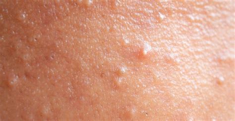 What Does Fungal Acne Look Like Beauty Supply Reviews
