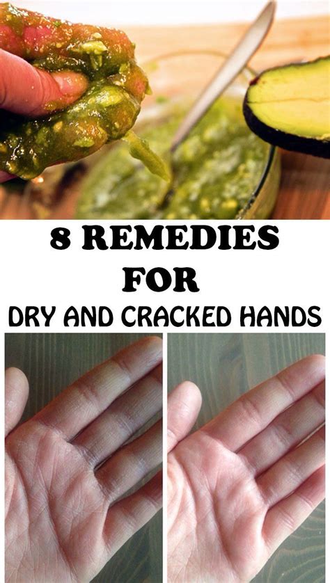 8 remedies for dry and cracked hands cracked hands dry hands remedy cracked hands remedy