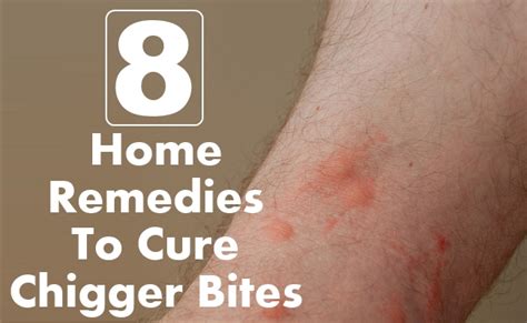 How long do chiggers live on your skin? Home Remedies | Find Home Remedy & Supplements - Part 3