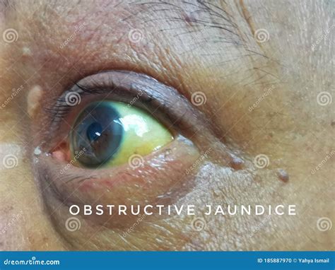 Jaundice Or Yellowish Discolouration Of Sclera Due To Obstructive