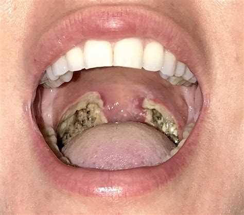 How To Cough Up Tonsil Stones Reddit Bronchitis Contagious