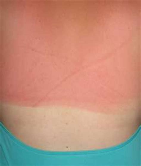 Images Of Burn And How To Treat 1st 2nd And 3rd Degree Sunburn With