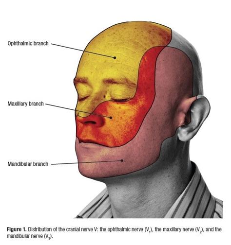 Trigeminal Neuralgia Tn Is Considered To Be One Of The Most Painful