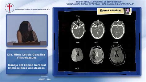 Manejo del Edema Cerebral Implicaciones Anestésica Dra Mirna L González Villavelazquez YouTube