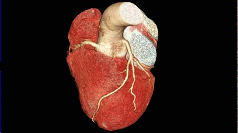 Angiotomografia O Que é Para Que Serve O Exame Tipos E Riscos