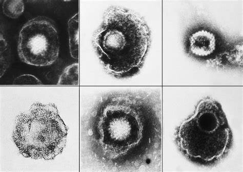 Диеты при эпштейн барр Anti-EBV IgG-EBNA (яд. бел.): причины назначения, симптомы, расшифровка Anti-EBV IgG-EBNA (яд. бел.): причины назначения, симптомы, расшифровка Диеты при эпштейн барр