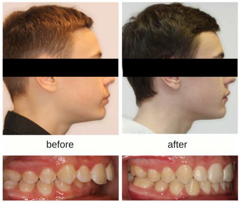 Recessive Lower Jaw In Kids Hometown Orthodontics