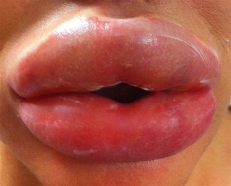 Lips Fillers Gone Wrong Kordel House Dental Practice