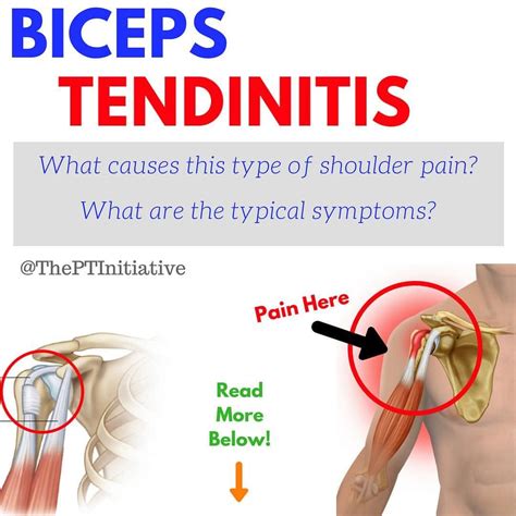Biceps Tendinitis Causes Symptoms And Rehab 😫having