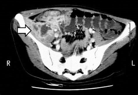 A Psoas Abscess Was Found On Abdominal Computed Tomography Download