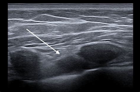 Supraclavicular Lymph Nodes Ultrasound Ultrasound Of Superficial