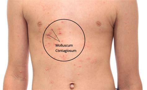 What Is Molluscum Contagiosum And Warts Signs Symptoms And Pictures