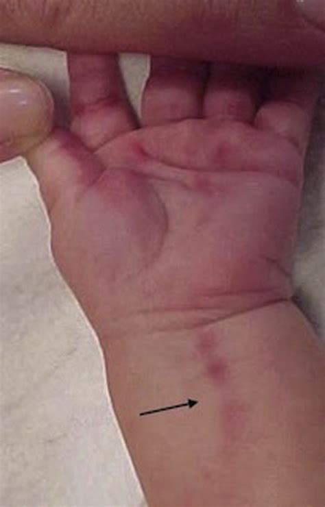 Palm Bruising In Infants A Recognizable Pattern Of Abuse Journal Of