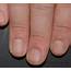 Fingernail Psoriasis Data