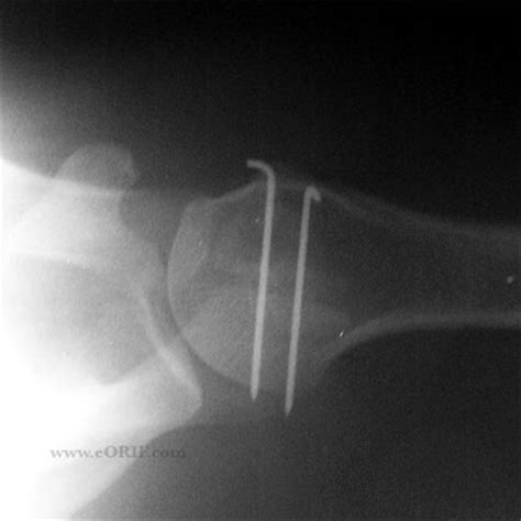 Os Acromionale S42.123A 811.01 | eORIF