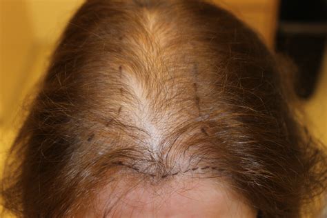 You probably know it as male pattern baldness. Hair Loss in Women Syracuse, NY | Syracuse Female Hair Loss