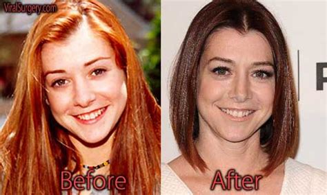 Alyson Hannigan Plastic Surgery Before And After Nose Job Pictures