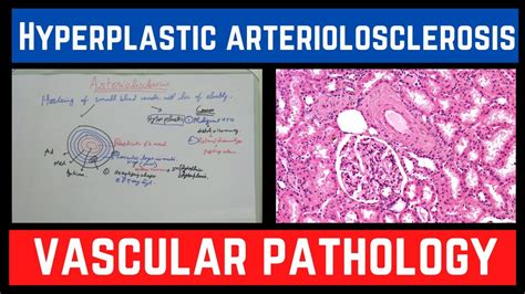 Hyperplastic Arteriolosclerosis And Its Causes Vascular Pathology