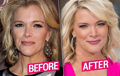 Megyn Kelly Facelift Did She Get Plastic Surgery