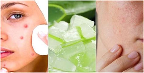 11 Tips To Avoid Pimples And Breakouts On Skin