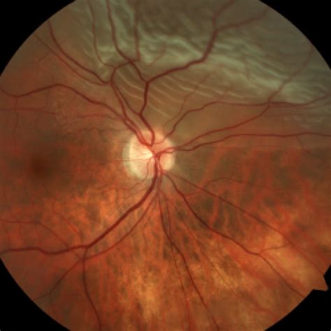 Retinal Detachment - Retina Associates of St. Louis