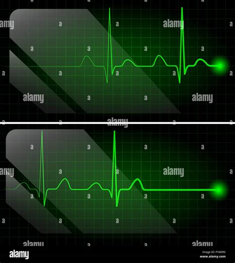 Resumen Latidos Del Corazón Electrocardiograma Realizado En Monitor