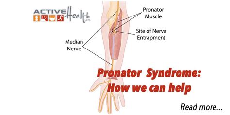 Pronator Syndrome Chiropractor Park Ridge Il Active Health