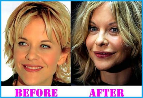 Meg Ryan Plastic Surgery Facelift Before And After Botox Injections