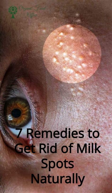 7 Remedies To Get Rid Of Milk Spots Naturally Organic Recipes