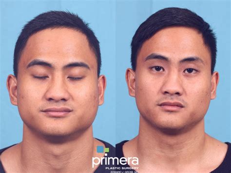 Buccal Fat Removal Before And After Photo Gallery Orlando Florida