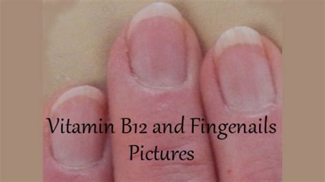 Vitamin B12 And Fingernails Pictures · Health Boundaries Nail