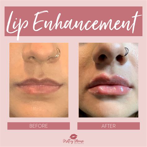 Pin On Before After Lip Filler