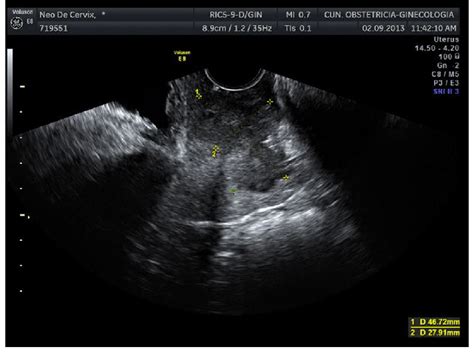 Transvaginal Ultrasound Showing A Large Cervical Cancer In Longitudinal