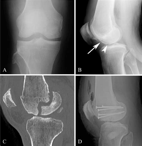 A Year Old Male With Hoffa Fracture Of The Medial Femoral Condyle Download Scientific