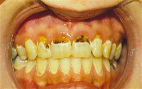 Tooth Decay Picture From Ui Dentistry Hardin Md