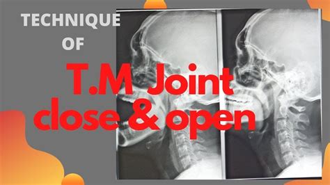 Technique Of Tm Joints Close And Open Mouth Ep 46temporomandibular