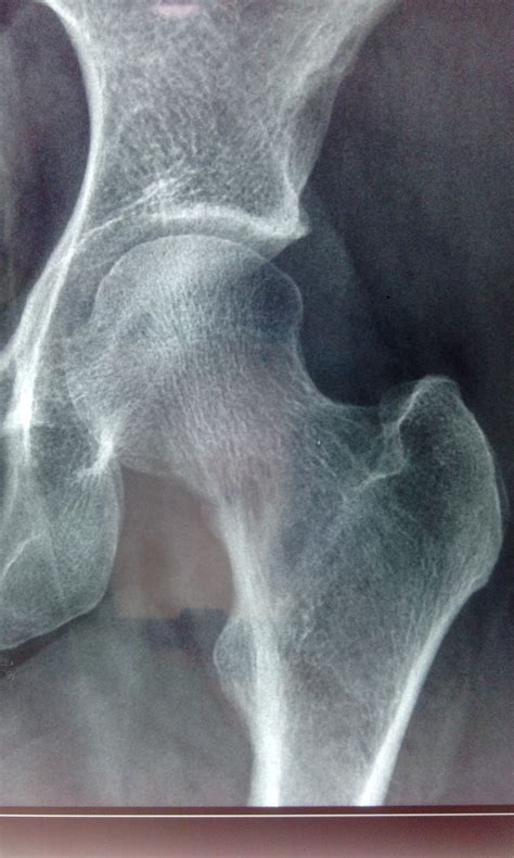 A 25f Presented With Severe Left Hip Pain For 2months Diagnosis And