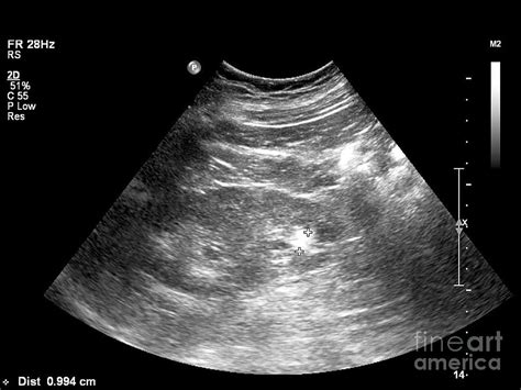 Gallstone Ultrasound Scan Photograph By Science Photo Library Pixels