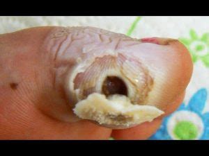 They usually seem on the hand and fingers. warts on hands Archives - Mirykal Moles Cure
