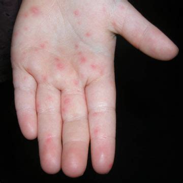 Hand, foot and mouth disease starts with blisters that begin as small red dots which later become ulcers. Hand Foot and Mouth Disease Pictures, Symptoms, Causes and ...