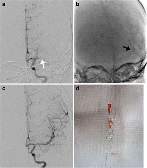 A Left Internal Carotid Artery Angiography Demonstrates Complete