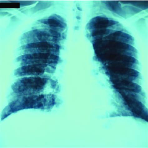 Posteroanterior View Chest Radiograph Showing Multiple Bilateral