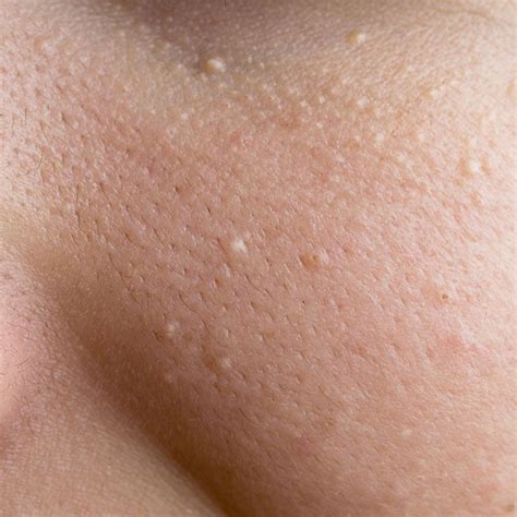 Whats That On Your Face Identify Common Skin Problems Skin Bumps