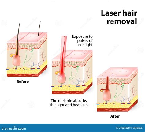 laser hair removal vector diagram 70025328